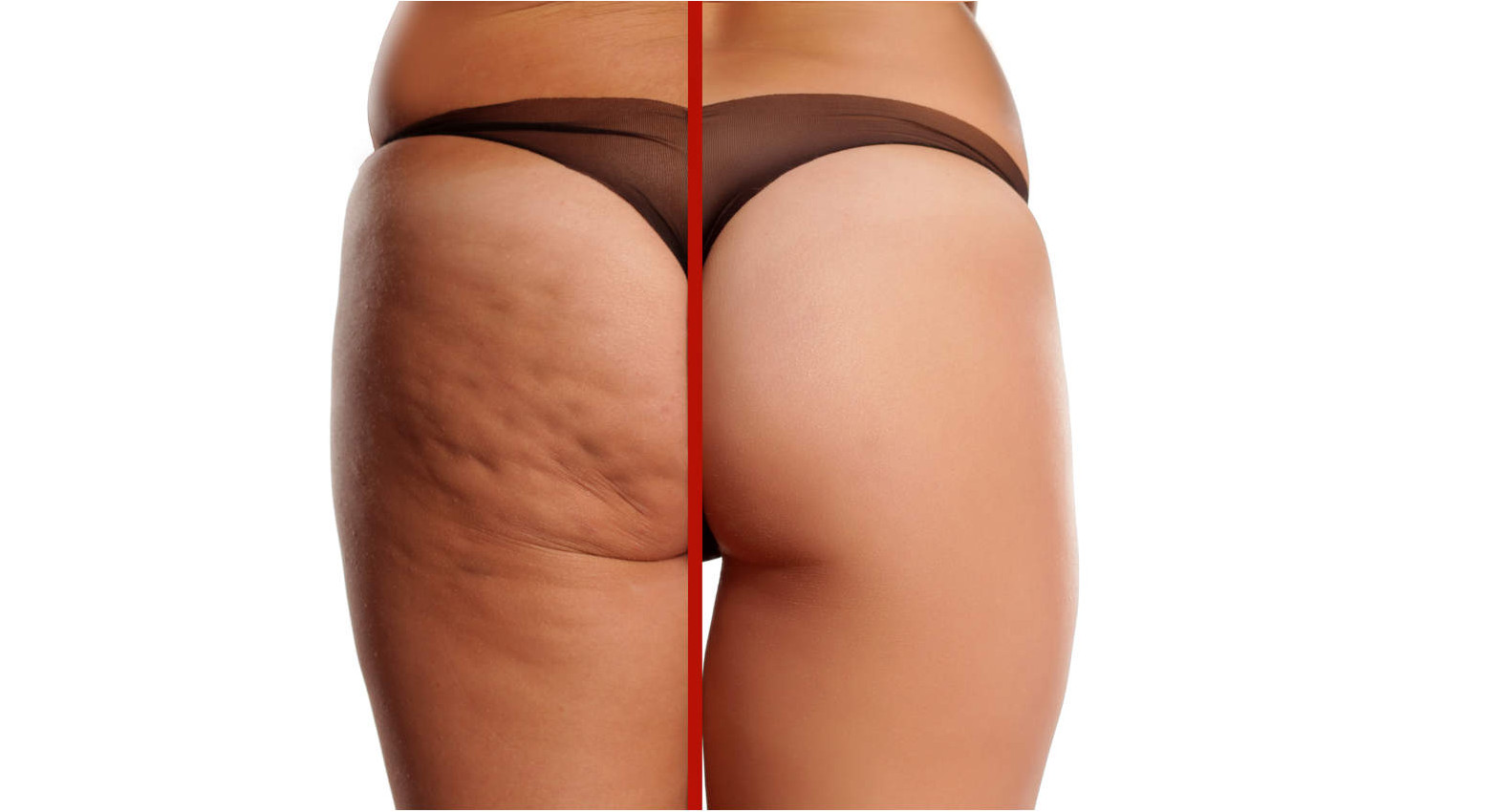 7 Rimedi naturali per la cellulite che (forse) non conosci